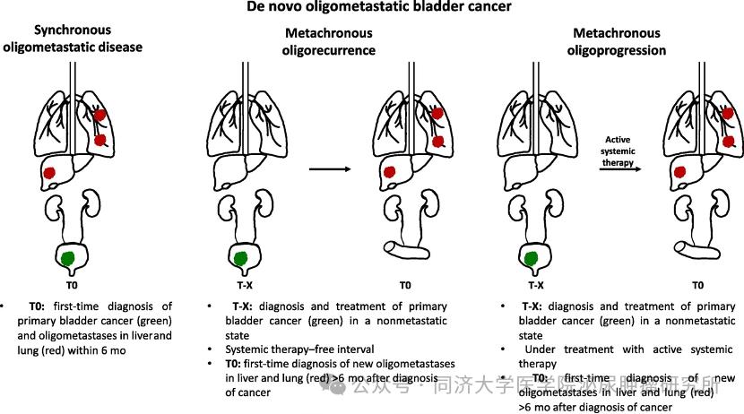 膀胱癌OMD诊断标准_膀胱癌寡转移性疾病治疗_diffusion definition